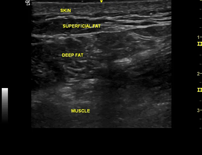 Ultrasound of Fat